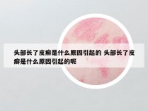 头部长了皮癣是什么原因引起的 头部长了皮癣是什么原因引起的呢