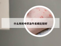 什么样的中药治牛皮癣比较好