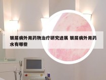 银屑病外用药物治疗研究进展 银屑病外用药水有哪些