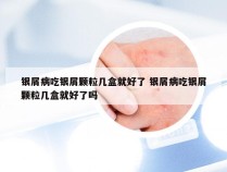 银屑病吃银屑颗粒几盒就好了 银屑病吃银屑颗粒几盒就好了吗