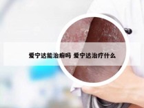 爱宁达能治癣吗 爱宁达治疗什么