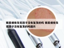 银屑病有生完孩子没有复发的吗 银屑病有生完孩子没有复发的吗图片