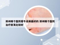 郑州哪个医院看牛皮癣最好的 郑州哪个医院治疗脱发比较好