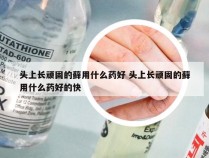 头上长顽固的藓用什么药好 头上长顽固的藓用什么药好的快