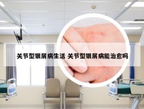 关节型银屑病生活 关节型银屑病能治愈吗