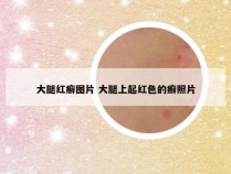 大腿红癣图片 大腿上起红色的癣照片