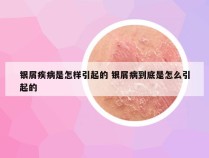 银屑疾病是怎样引起的 银屑病到底是怎么引起的