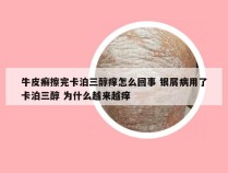 牛皮癣擦完卡泊三醇痒怎么回事 银屑病用了卡泊三醇 为什么越来越痒