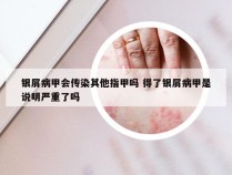 银屑病甲会传染其他指甲吗 得了银屑病甲是说明严重了吗