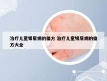 治疗儿童银屑病的偏方 治疗儿童银屑病的偏方大全