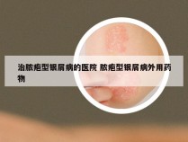 治脓疱型银屑病的医院 脓疱型银屑病外用药物