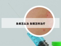 鱼癣怎么治 鱼鳋怎样治疗