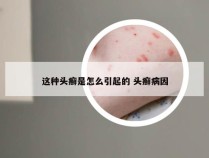 这种头癣是怎么引起的 头癣病因