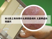 幼儿脸上有白斑什么原因造成的 儿童脾虚白斑图片