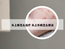 头上癣怎么治疗 头上长癣怎么根治