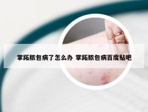 掌跖脓包病了怎么办 掌跖脓包病百度贴吧