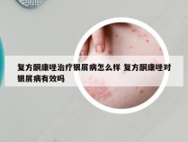 复方酮康唑治疗银屑病怎么样 复方酮康唑对银屑病有效吗