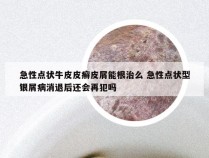 急性点状牛皮皮癣皮屑能根治么 急性点状型银屑病消退后还会再犯吗