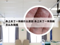 身上长了一块癣什么原因 身上长了一块像癣怎么办很痒