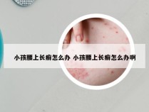 小孩腰上长癣怎么办 小孩腰上长癣怎么办啊