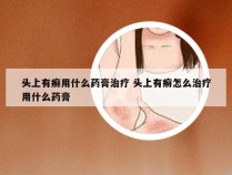 头上有癣用什么药膏治疗 头上有癣怎么治疗用什么药膏