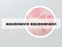 美国治银屑病的药膏 美国治银屑病的最新药