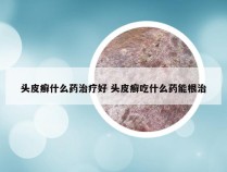 头皮癣什么药治疗好 头皮癣吃什么药能根治