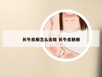 长牛皮癣怎么去除 长牛皮肤癣