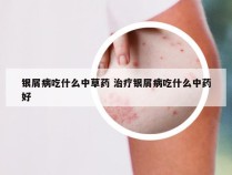 银屑病吃什么中草药 治疗银屑病吃什么中药好