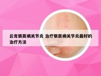 云克银屑病关节炎 治疗银屑病关节炎最好的治疗方法