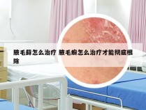 腋毛藓怎么治疗 腋毛癣怎么治疗才能彻底根除