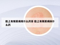 脸上有银屑病用什么药膏 脸上有银屑病抹什么药