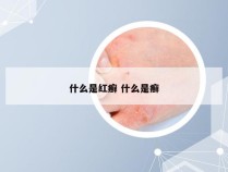 什么是红癣 什么是癣