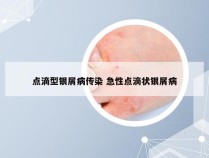 点滴型银屑病传染 急性点滴状银屑病