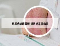 银屑病病因最新 银屑病常见病因