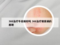 308治疗牛皮癣好吗 308治疗银屑病的原理