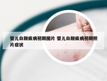 婴儿白颠疯病初期图片 婴儿白颠疯病初期照片症状