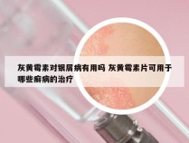 灰黄霉素对银屑病有用吗 灰黄霉素片可用于哪些癣病的治疗