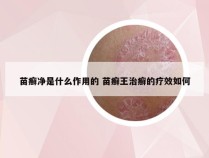 苗癣净是什么作用的 苗癣王治癣的疗效如何