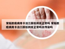 掌跖脓疱病用卡泊三醇后剥皮正常吗 掌跖脓疱病用卡泊三醇后剥皮正常吗会传染吗