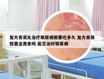 复方青黛丸治疗银屑病需要吃多久 复方青黛胶囊含激素吗 能否治好银屑病