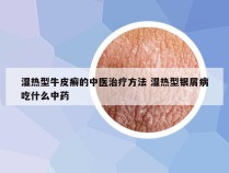 湿热型牛皮癣的中医治疗方法 湿热型银屑病吃什么中药