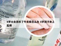 8岁小女孩长了牛皮癣怎么办 8岁孩子身上起癣