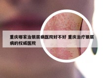 重庆哪家治银屑病医院好不好 重庆治疗银屑病的权威医院