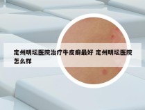 定州明坛医院治疗牛皮癣最好 定州明坛医院怎么样