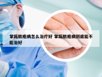 掌跖脓疱病怎么治疗好 掌跖脓疱病到底能不能治好