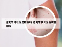 达克宁可以治皮肤癣吗 达克宁软膏治癣有作用吗