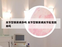 关节型银屑病多吗 关节型银屑病关节能变回来吗