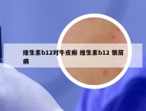 维生素b12对牛皮癣 维生素b12 银屑病