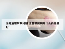 治儿童银屑病绝招 儿童银屑病用什么药膏最好